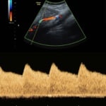 Dopplerultraschall